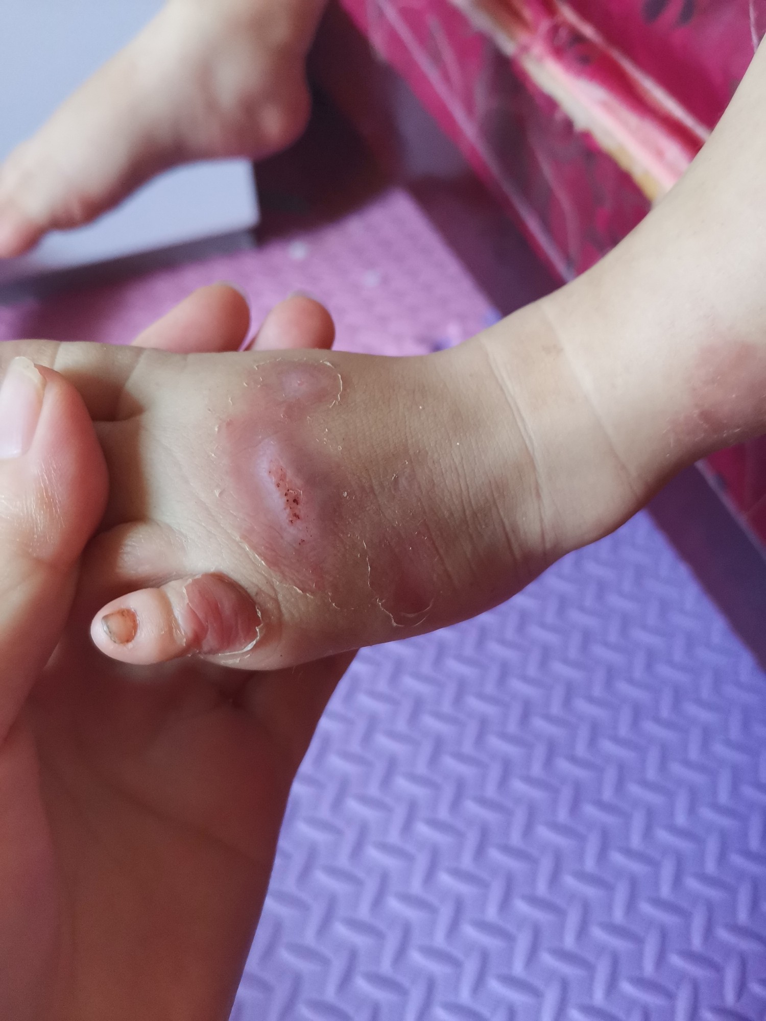 宝宝烫伤如何正确处理和护理烫伤疤痕？